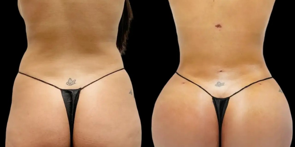Fat transfer in Dubai: Modern Techniques for Butt Fat Transfer