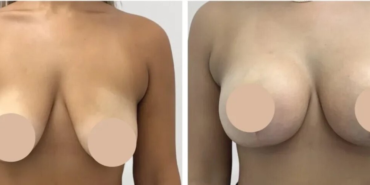 Breast Reduction in Dubai for Improved Shape, Comfort, and Confidence