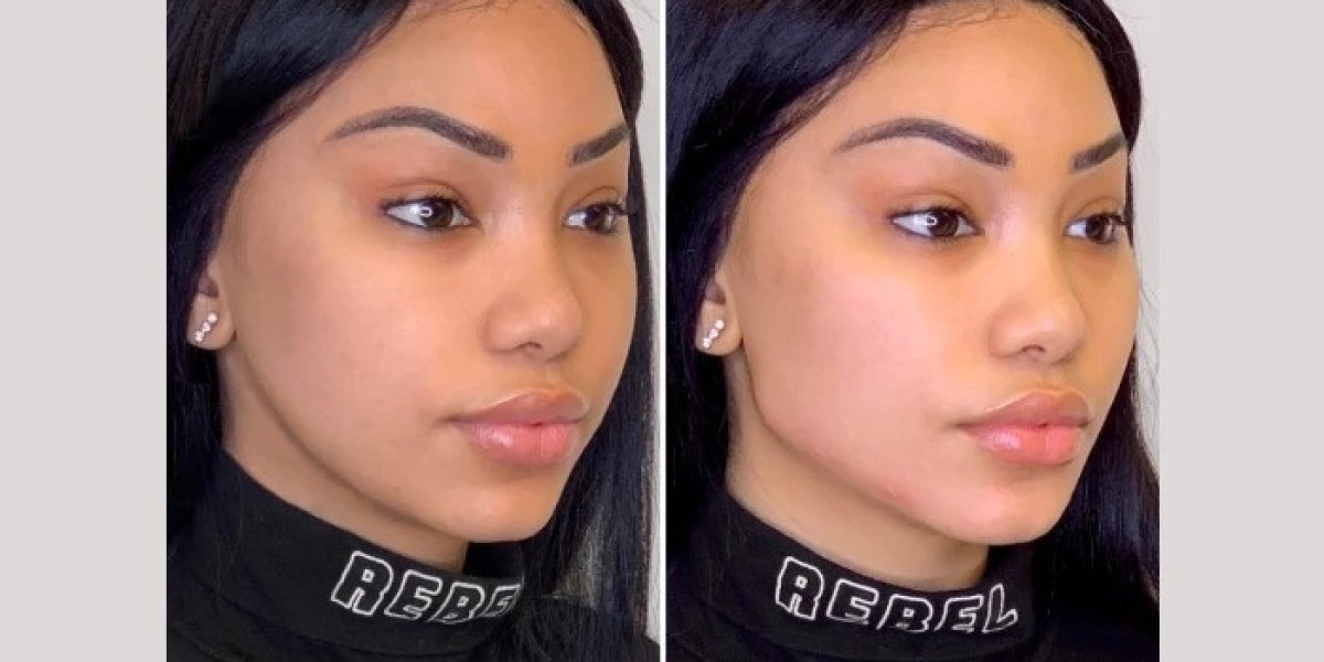 Best Doctors in Dubai Offering Advanced Thread Lift Treatments for Youthful Skin
