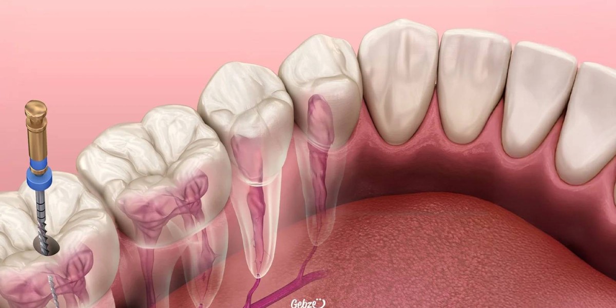 Root Canal Treatment in Dubai: Is It Painful?