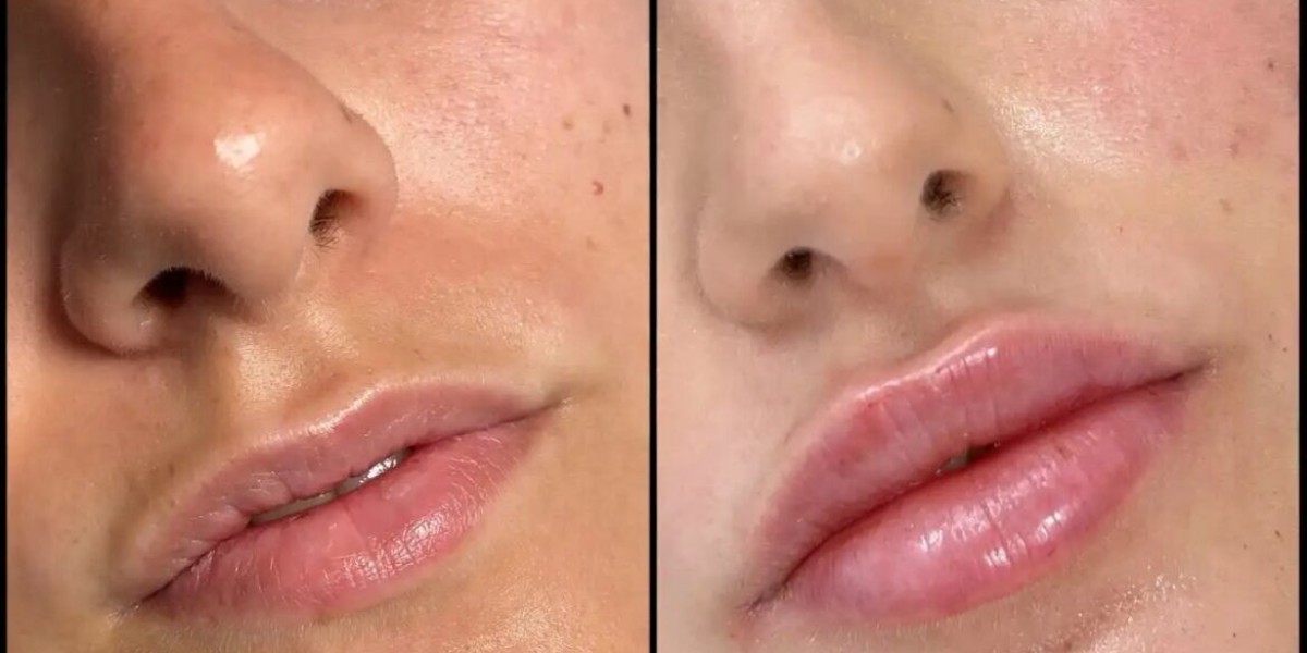 Best Doctors in Dubai for Fillers: Expert Solutions for Facial Volume Restoration