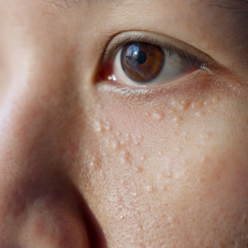Syringoma Removal Treatment | AH Advanced Skin Specialist