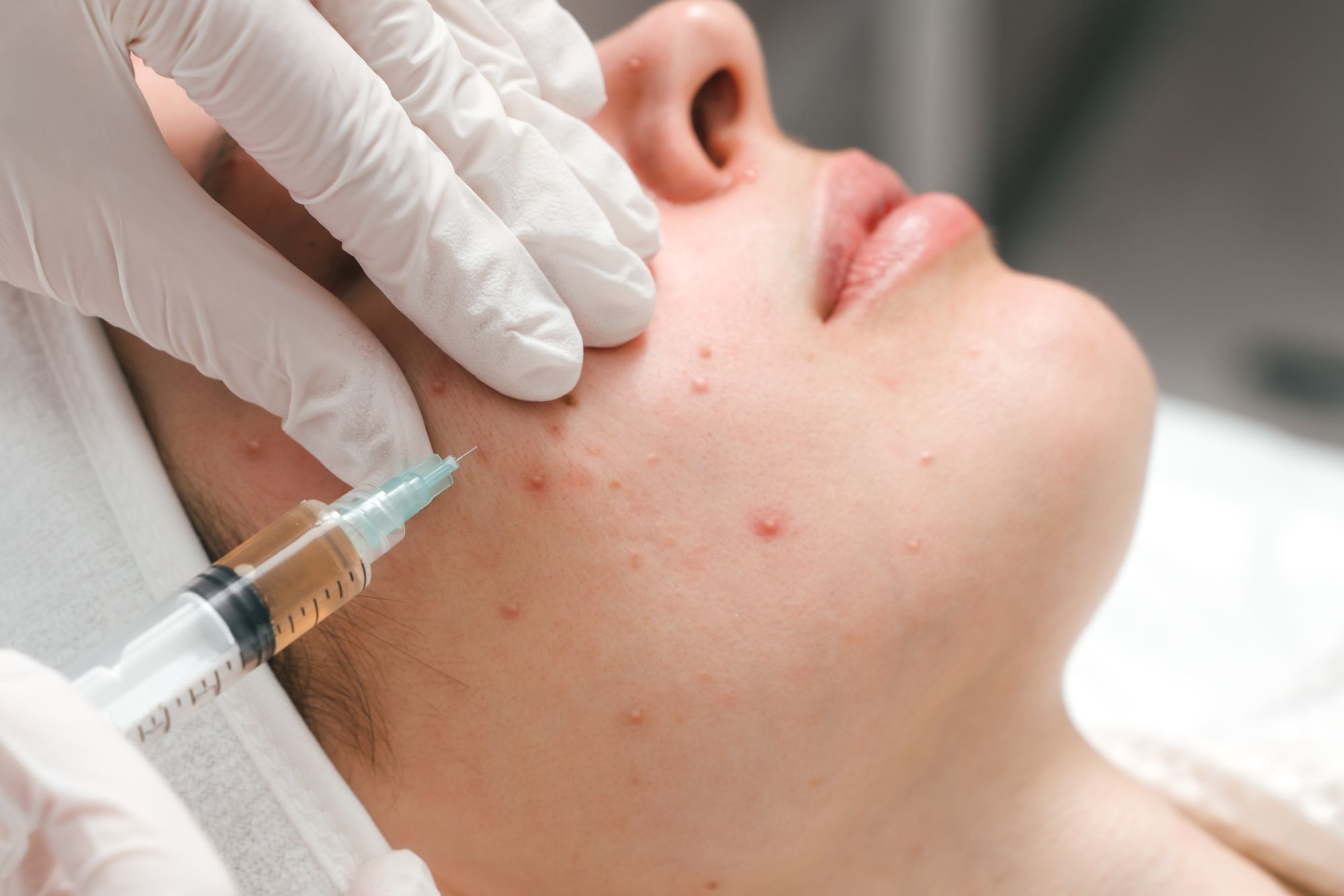 Pimple Scar Treatment Price Malaysia - Cost Guide & Best Options