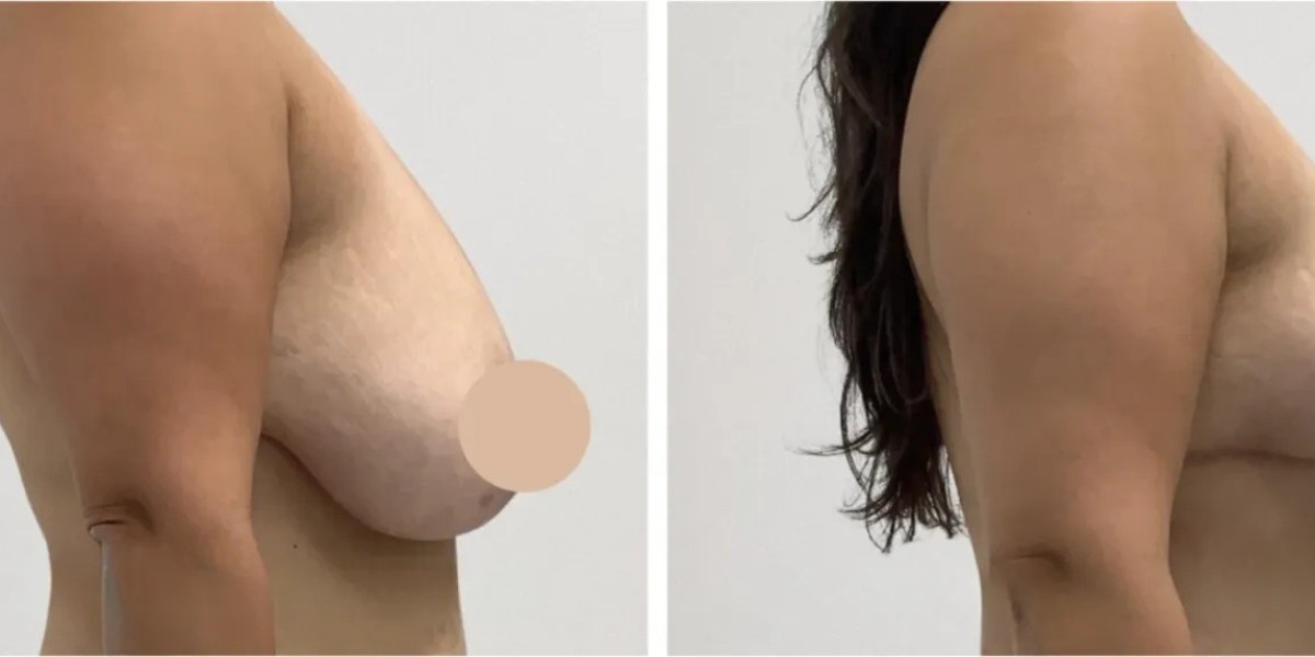 Breast Lift in Dubai for Confidence-Boosting Results