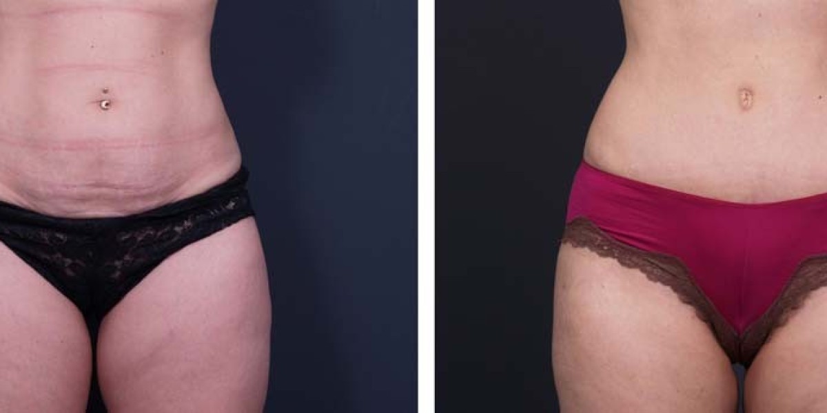 Tummy Tuck in Dubai Recovery: Week-by-Week Guide