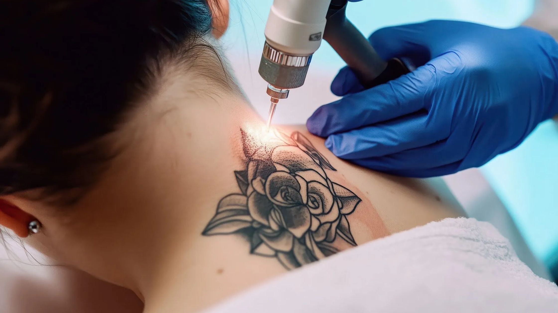 How Much Does Tattoo Removal Cost in Northamptonshire?
