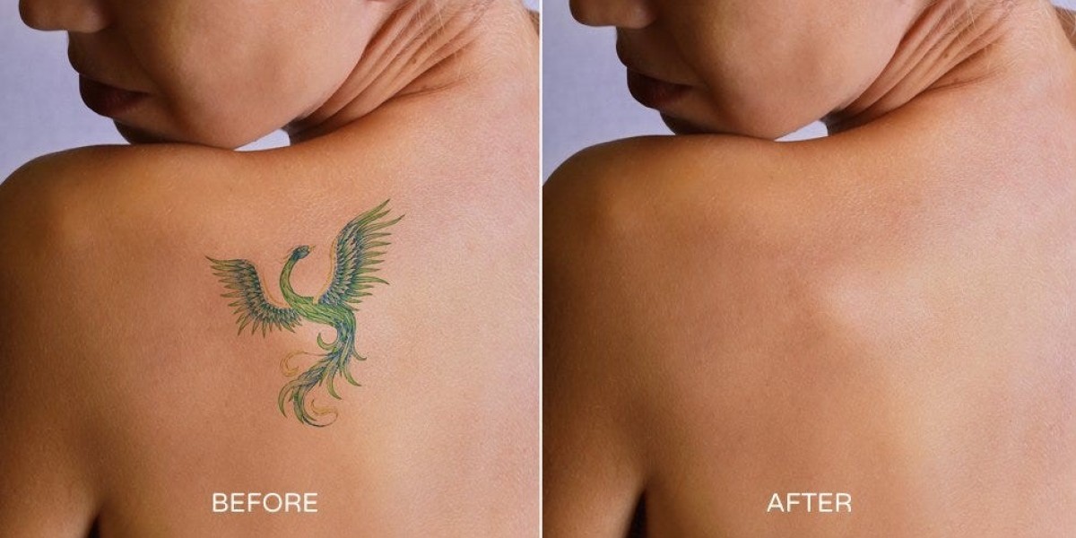 Tattoo Removal in Dubai: Healing Tips After Sessions
