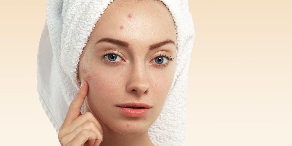 Acne Treatment in Manchester: Clear Skin Solutions for Every Skin Type