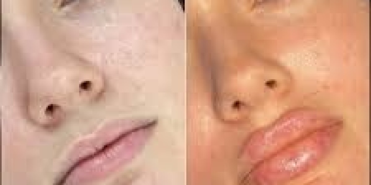 Best Doctors in Dubai for Complete Fillers Care