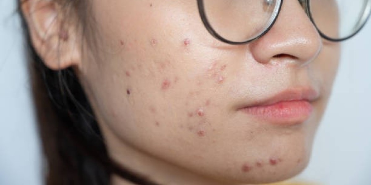 The Role of Advanced Skin Treatments in Acne Scar Reduction