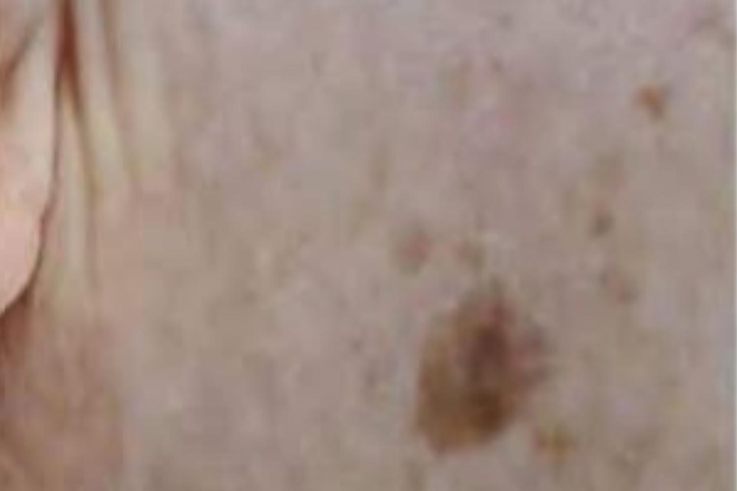 Age Spot Removal in Milton Keynes | Call 770-383-0047