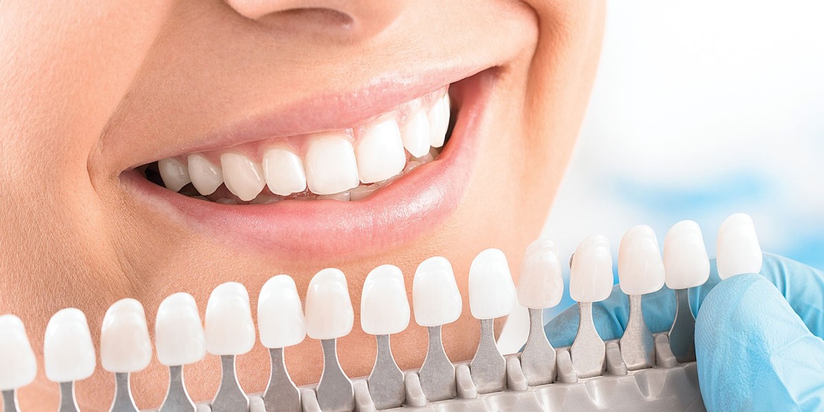 Best Dental Veneers in Dubai for Smile Makeovers