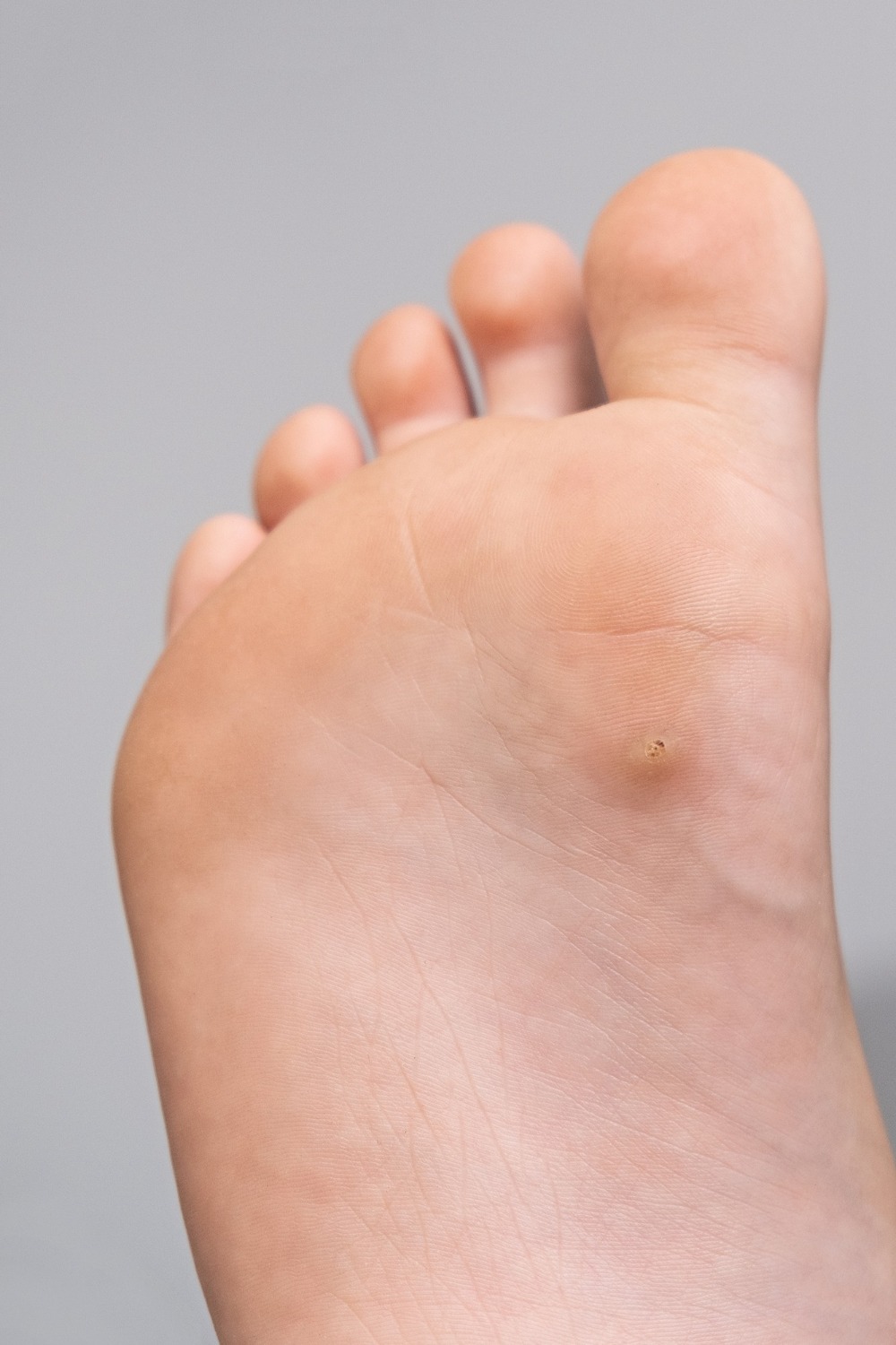 Best Wart Removal in Milton Keynes | Trusted Clinic