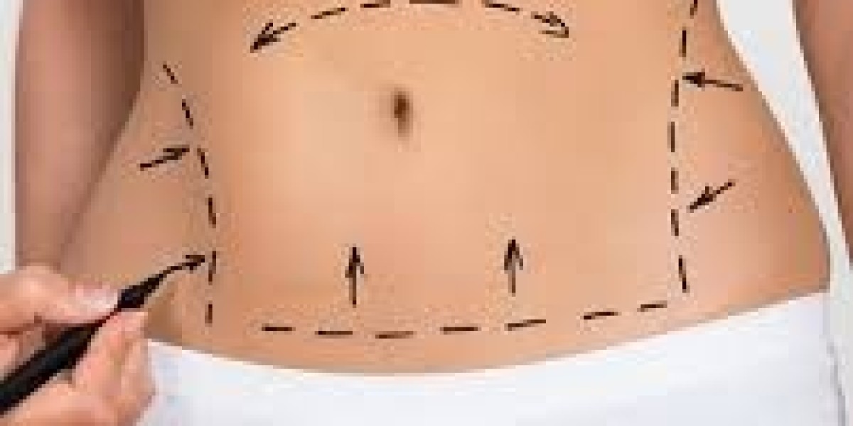 Preparing for Liposuction Surgery in Dubai with Confidence | Complete Patient Guide