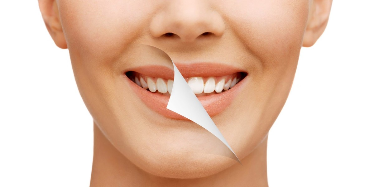 Teeth Whitening in Dubai: Treatment Options