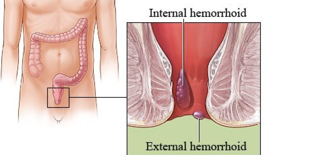 The Benefits of Choosing Haemorrhoids Treatment in Dubai | Complete Guide