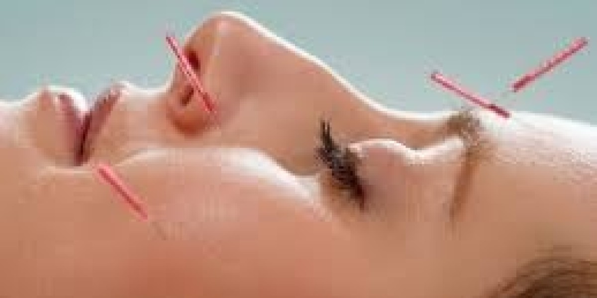 Acupuncture Treatment in Dubai | Improve Health & Wellness Naturally