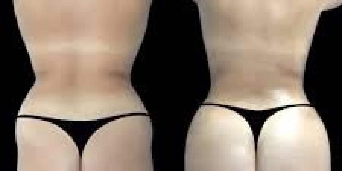 Butt Fat transfer in Dubai: Sitting After Butt Fat Transfer