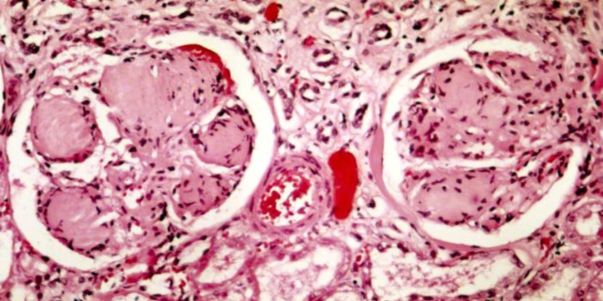 Understanding FSGS, Nephrotic Syndrome, and Its Risk Factors