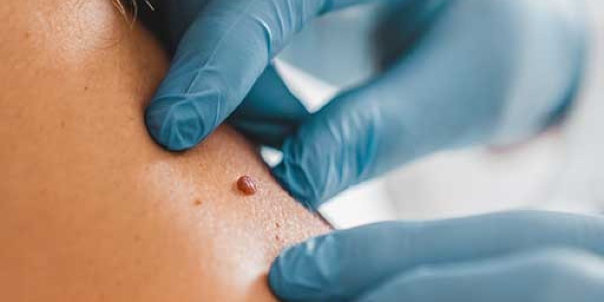 How Is Mole Removal Performed? A Simple Guide for Dubai Patients
