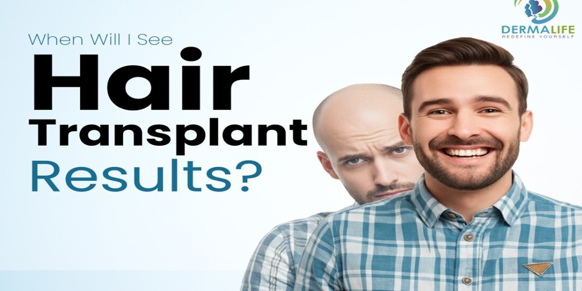 What Happens to Your Existing Hair After a Hair Transplant? A Long-Term Guide for Delhi Patients