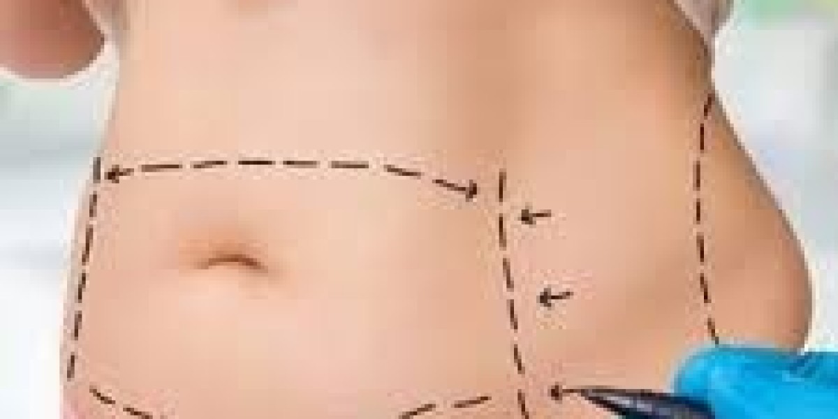 What to Expect From a Liposuction Consultation at Tajmeels Clinic